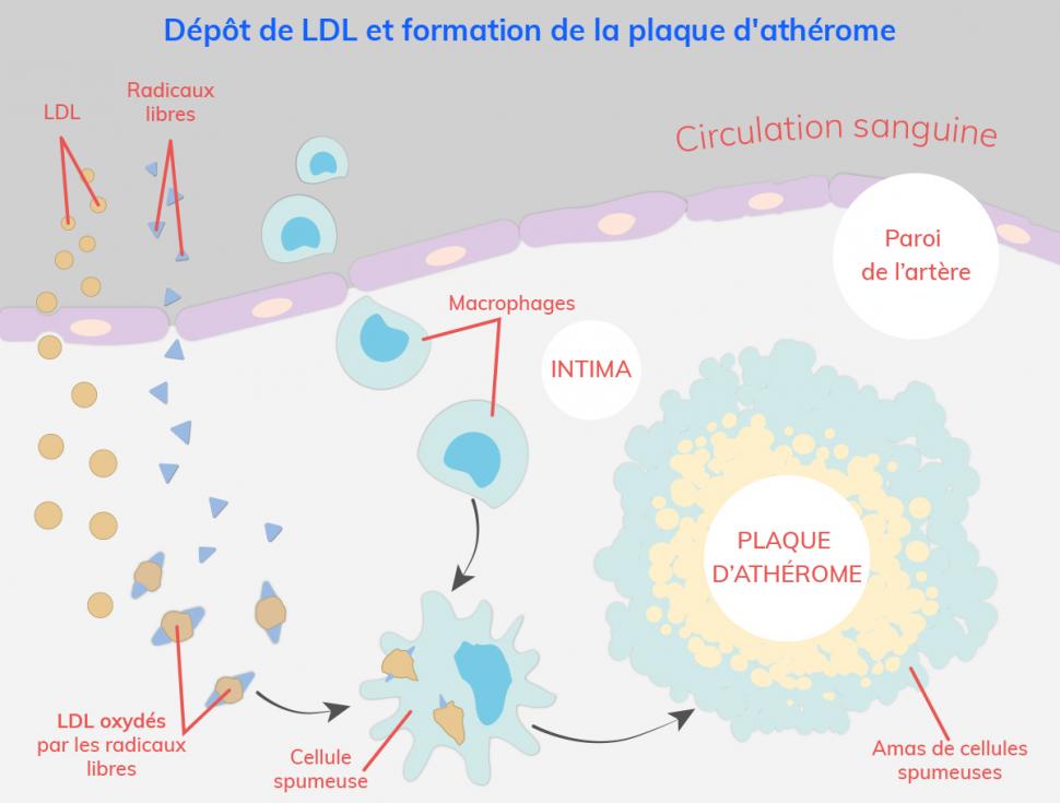 L’excès de mauvais cholestérol LDL s’accumule au niveau des artères pour former des plaques d’athérome