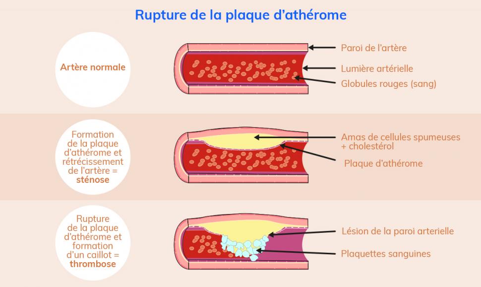 L’accumulation de cholestérol peut causer une rupture de la plaque d’athérome, boucher la circulation sanguine et provoquer des accidents cardiovasculaires