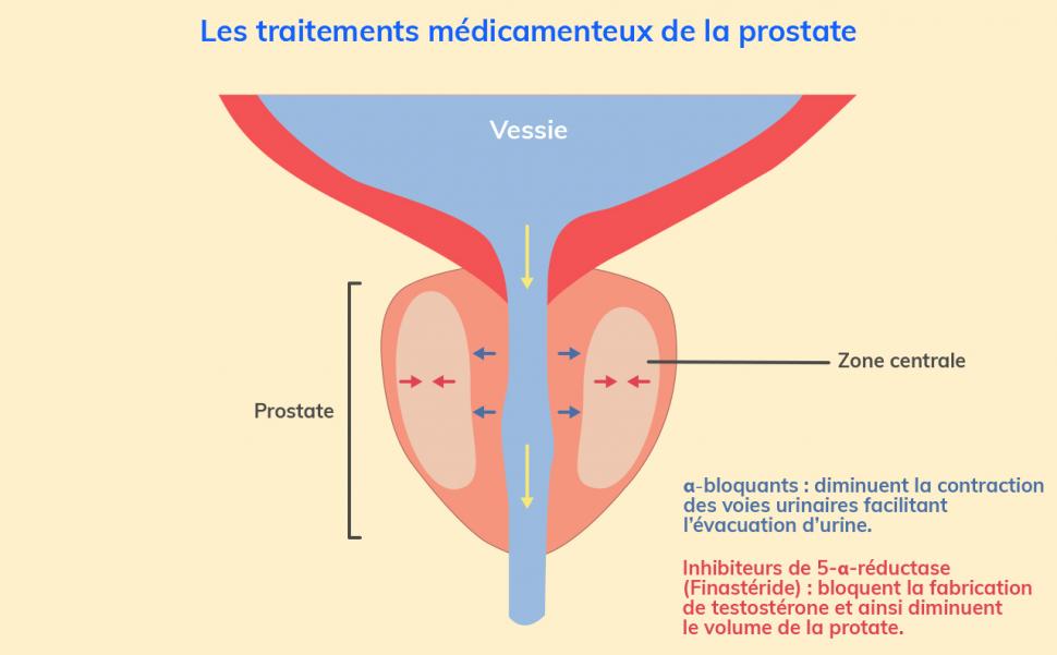 Trouver un soutien pour vivre sereinement l’hypertrophie bénigne de la prostate