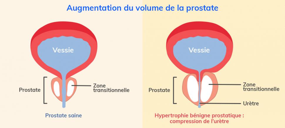 Inflammation de la prostate