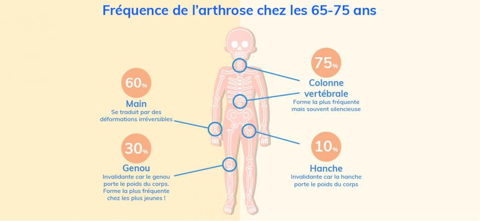 L’arthrose touche le plus souvent la colonne vertébrale et les mains, mais aussi la hanche et le genou