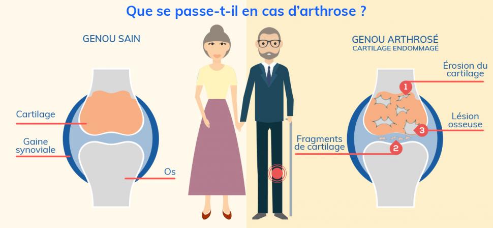 L’arthrose est une atteinte du cartilage, provoquant des lésions au niveau des articulations.