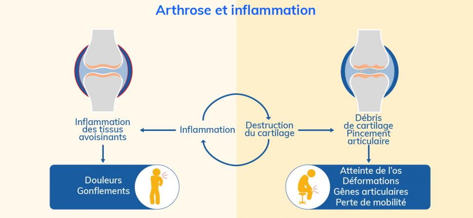 L’inflammation et la destruction du cartilage provoquent douleurs et perte de mobilité 