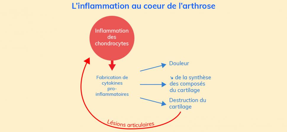 L’arthrose est une maladie à composante inflammatoire